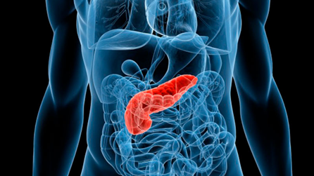 Esquema sobre estroma gist y su tratamiento con sunitinib